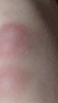 I Show You the Bruises on My Legs After Rough Sex