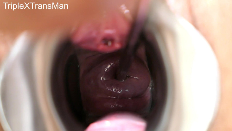TripleXTransMan: मेरी गर्भाशय ग्रीवा में घुसना!