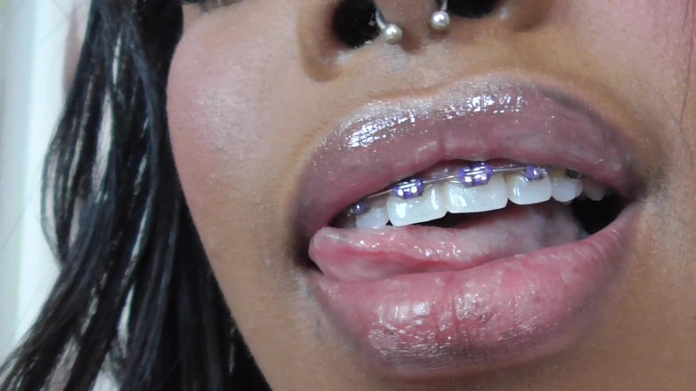 Solo Austria: Black girl teeth brace fetish!