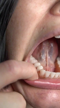 Mouth Tour with Dentures in
