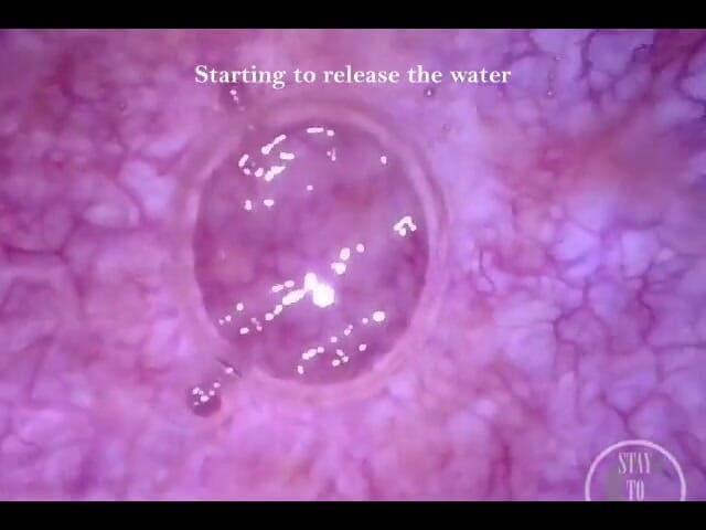 Lina Free: 第一人称视角 内窥镜 导尿管 膀胱膨胀！