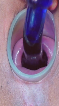 I Fuck My Cervix with a Blue Dildo with 3.5 and 4.5 Cm Basin.