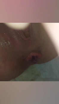 Prolapsed Ass