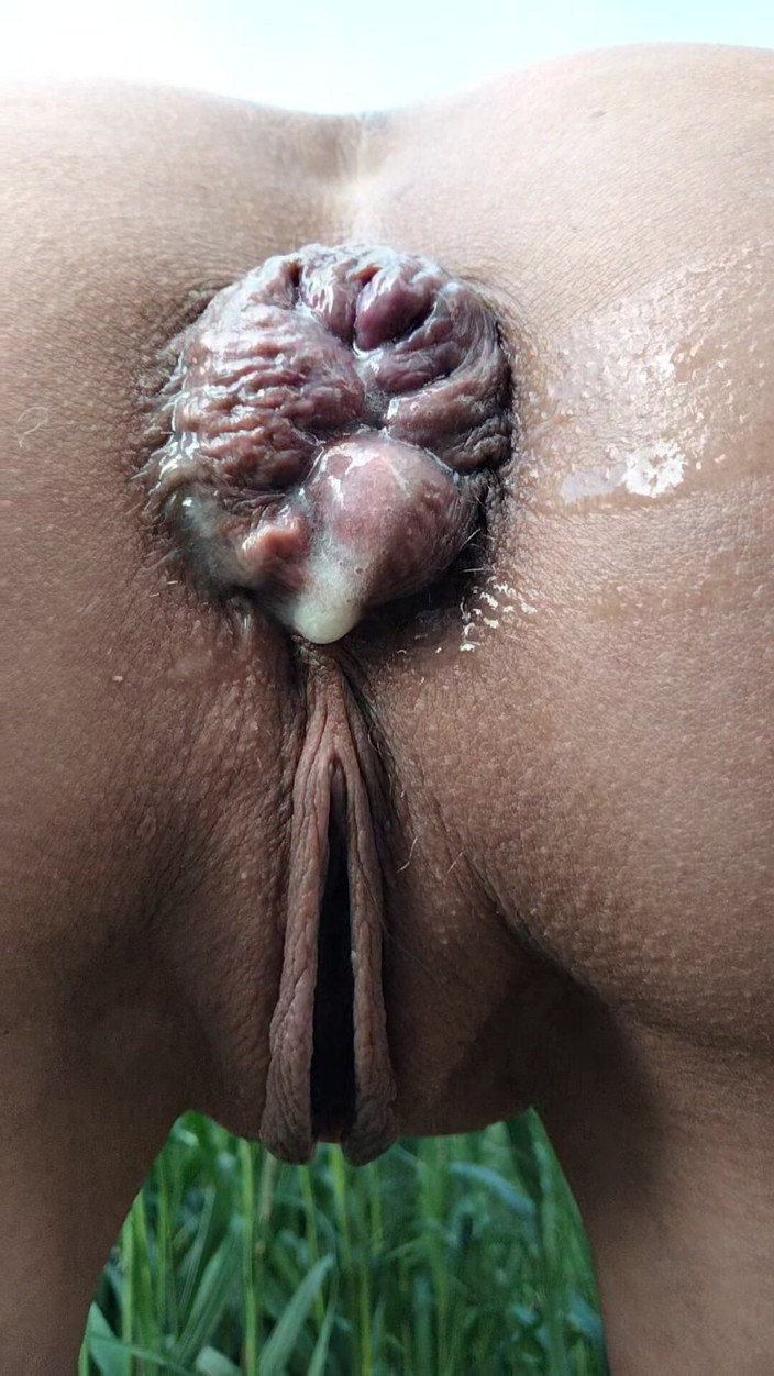 Nadin: 肛門と脱出