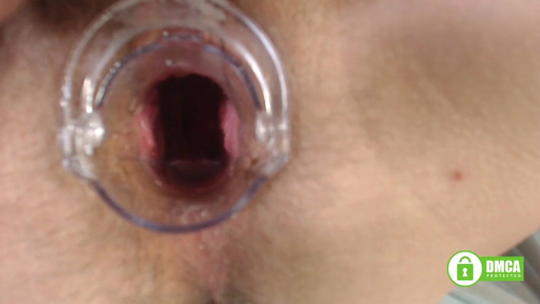 Miodelka: Gyno exam with speculum close up in hairy pussy