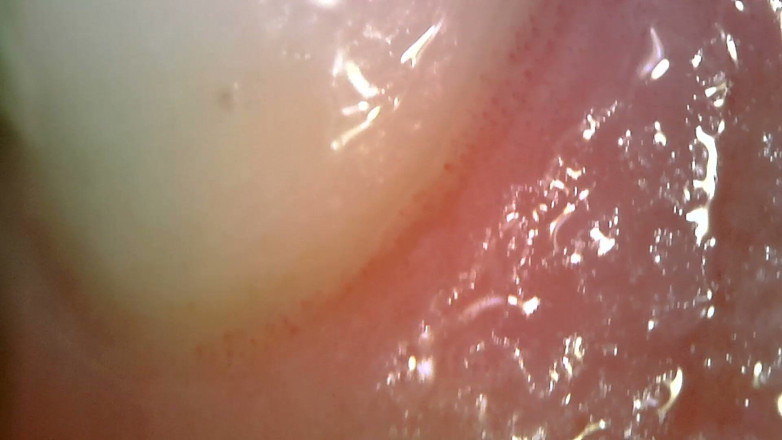 Nicoletta Embassi: Pemeriksaan Oral Endoskop Perubatan: Gummy Chewing, Gigi melampau &amp; Macro lidah