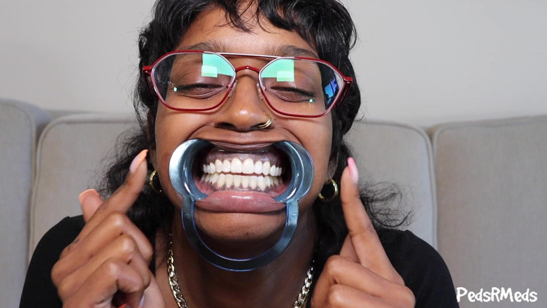 PedsRMeds: Youronlyphoenix Dental Retractor Mouth Tour