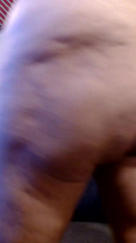 Cellulite Squeeze