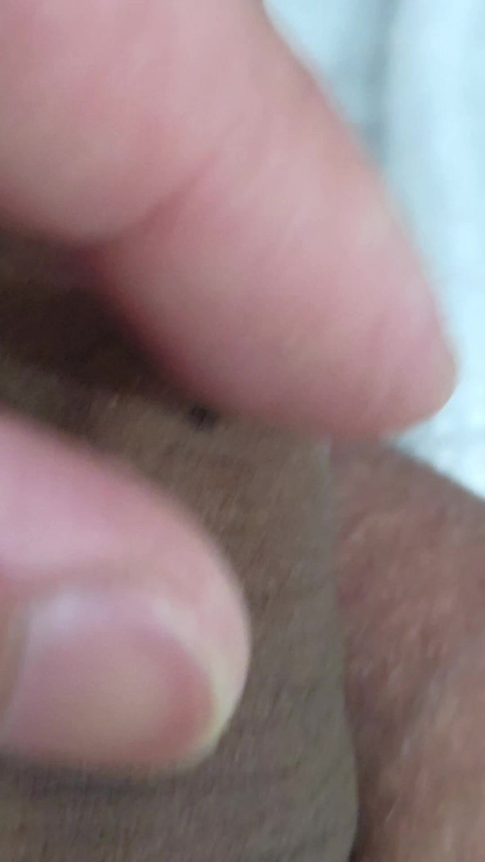 Lkdick8: ¿Qué son estas manchas en mi pene?