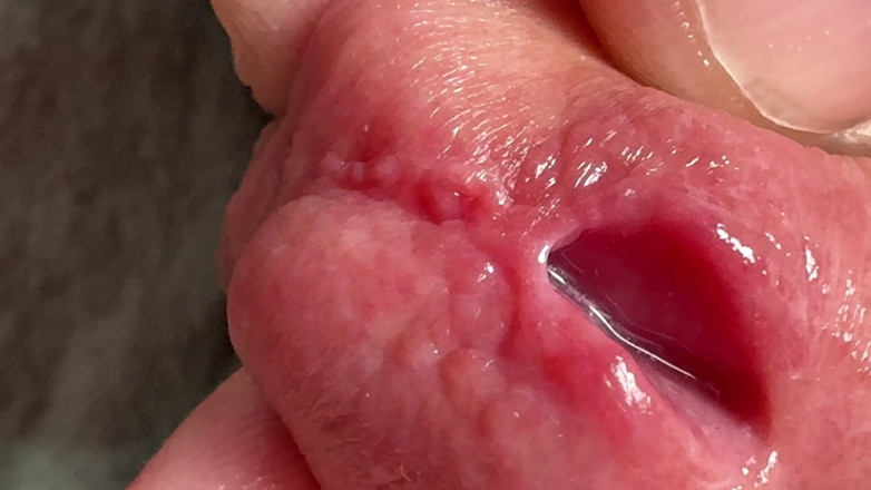 Leonardo-1974: Ngón tay trong dương vật. Lỗ thâm nhập dương vật.