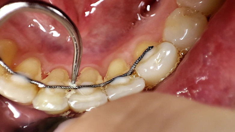 Princess18_: Čištění zubů kartáčkem na zuby, irigátor, zubní hák