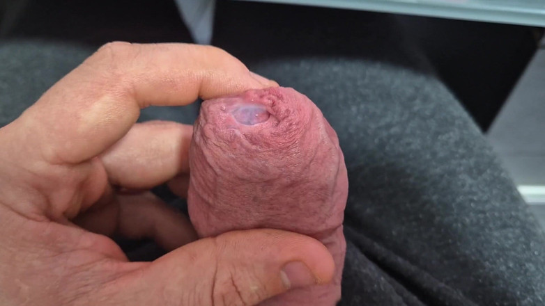 GloomyChase977: Enge Phimosis vorhautdehnung mit abspritzen!