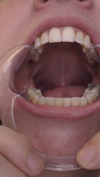 Occhiali e gape: sessione di sbavatura con speculum dentale di 11 minuti