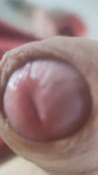 Opening the Scar of the Rough Frenulum!