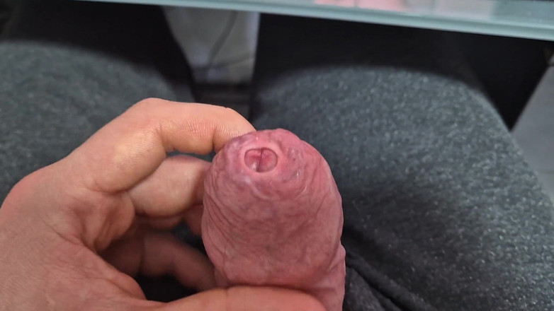 GloomyChase977: Sıkı fimosis sünnet derisi boşalma ile esneme!