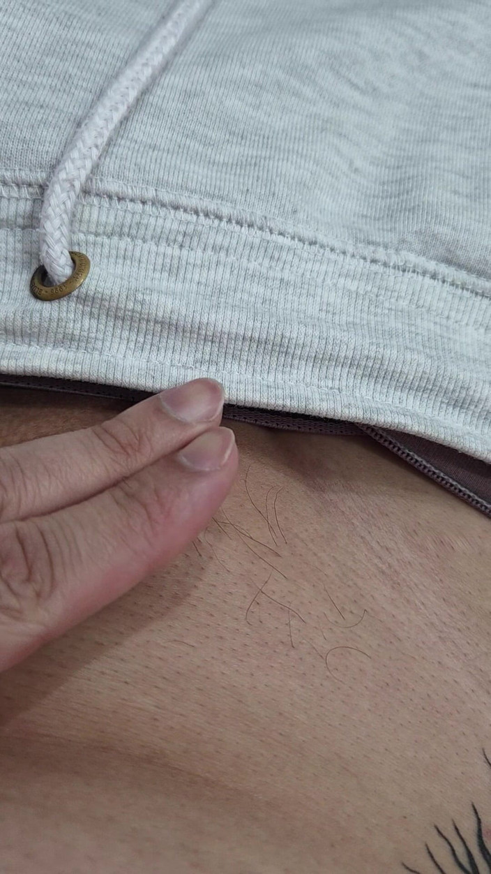 Lkdick8: Părul de pe penisul meu - Îndepărtare a părului cu plumb