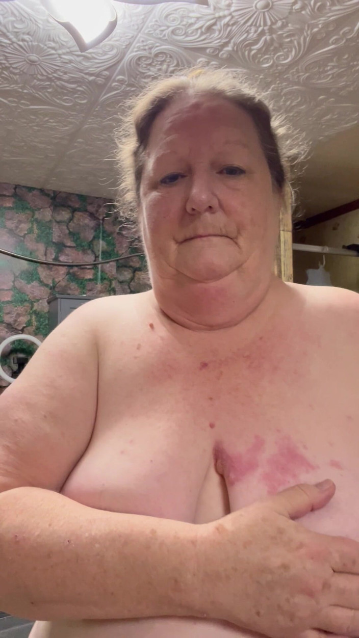 PlayfulRose1: Slecht geval van gordelroos