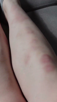 I Show You the Bruises on My Legs After Rough Sex