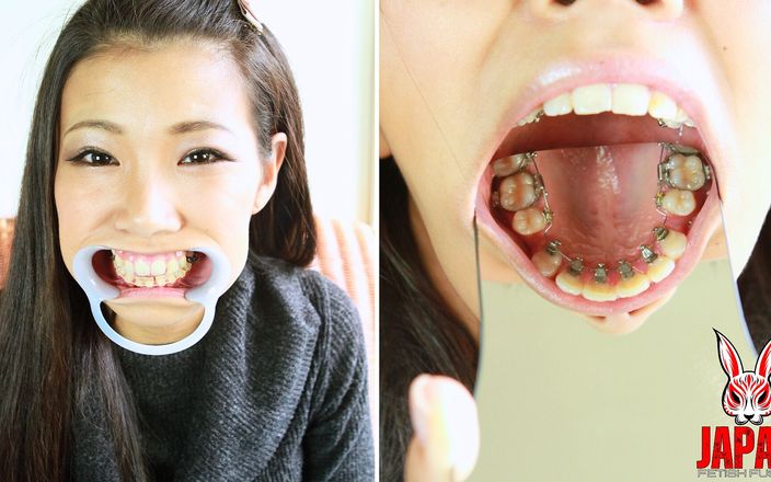 Japan Fetish Fusion: Ortho Obsession: My Journey with Braces
