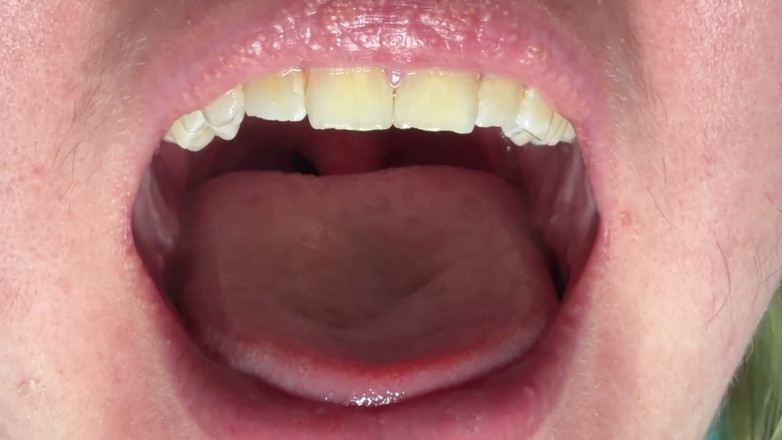 Spunk Kip: Mulut &amp; tonsil close-up