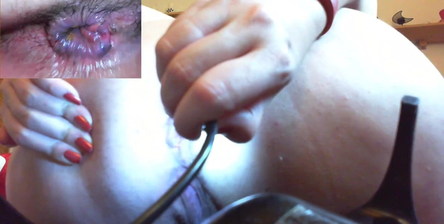 Nicoletta Embassi: Medical Anal Endoscope Fisting and Extreme Masturbation