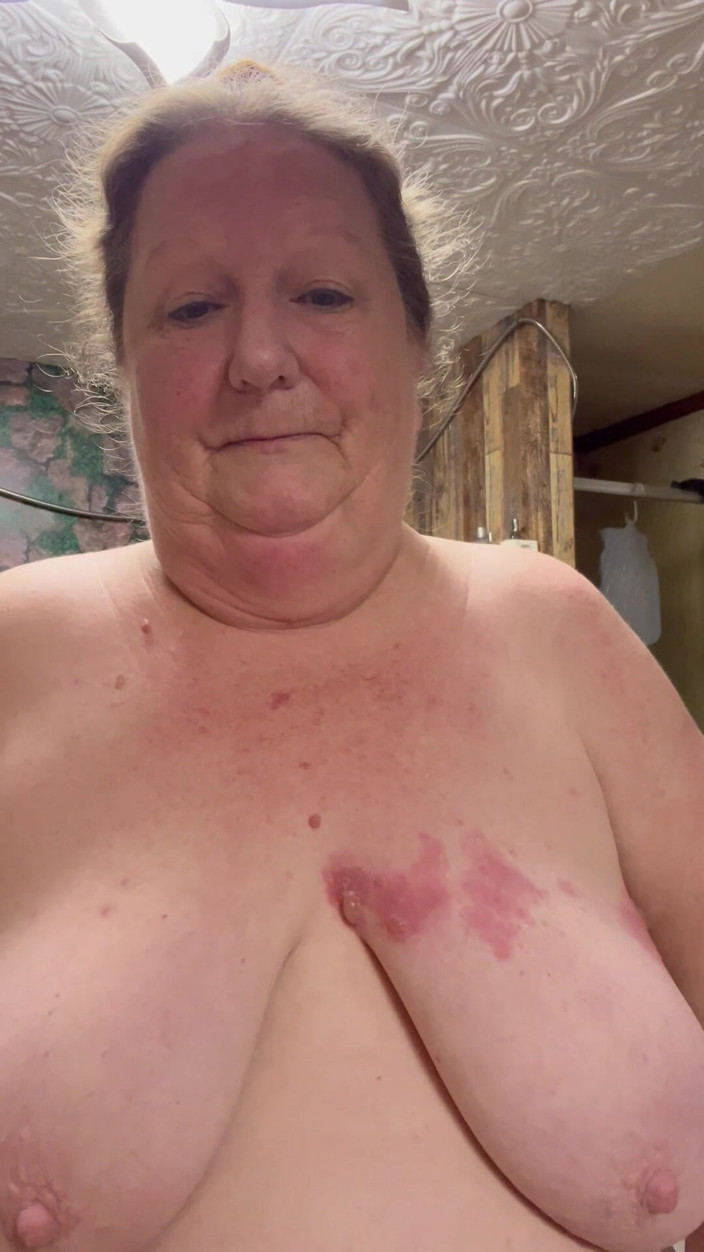 PlayfulRose1: Bad Case of Shingles