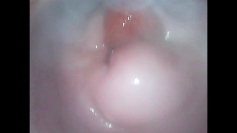 LizAngel: Endoskopische wieder in meiner vagina