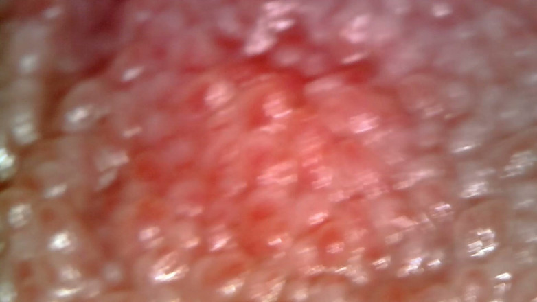 Nicoletta Embassi: Esame Orale Medico Endoscopico: Gommosa Da Masticare, Denti Estremi E...