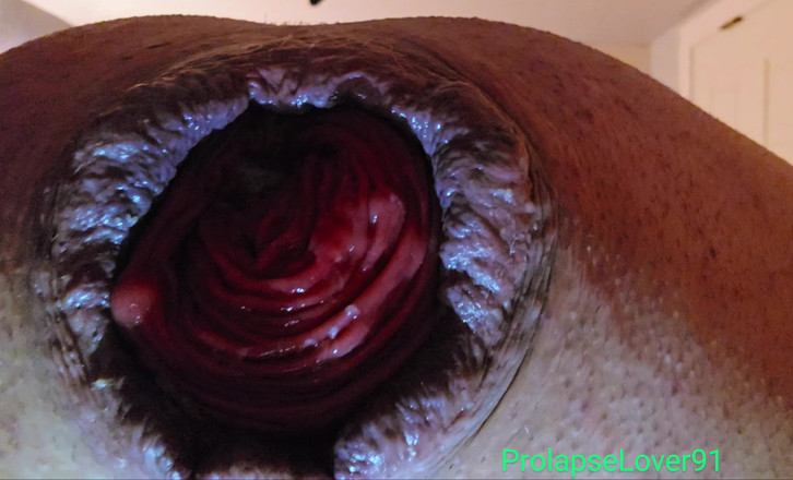 ProlapseLover91: インフレータブルバットプラグによるクローズアップアナル脱出