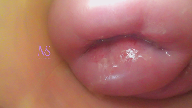 Maya Simons: Tử cung cổ tử cung