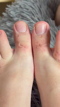 Hard Feet Biting