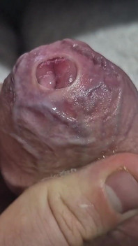 Uncut Tight Phimosis Cock Foreskin Stretched Close up