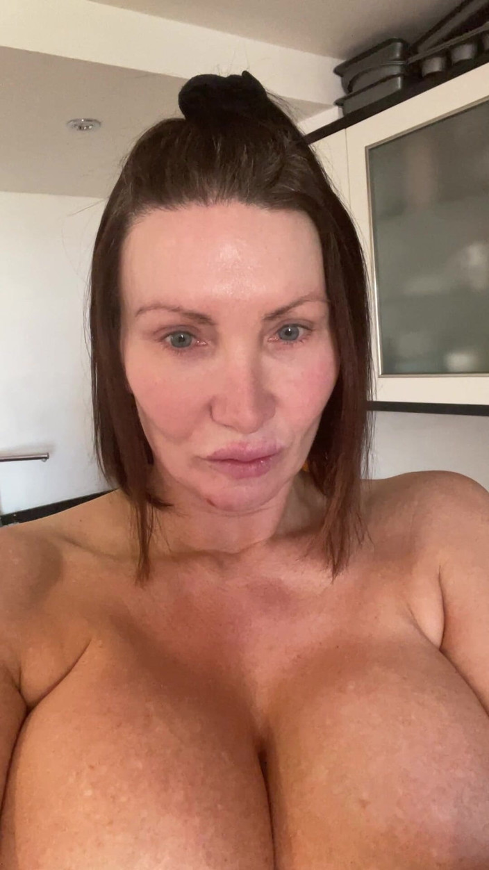 Sophie James: 임플란트 제거 후 첫 번째 비디오