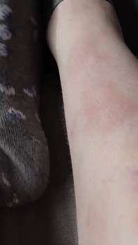 I Show You the Bruises on My Legs After Rough Sex