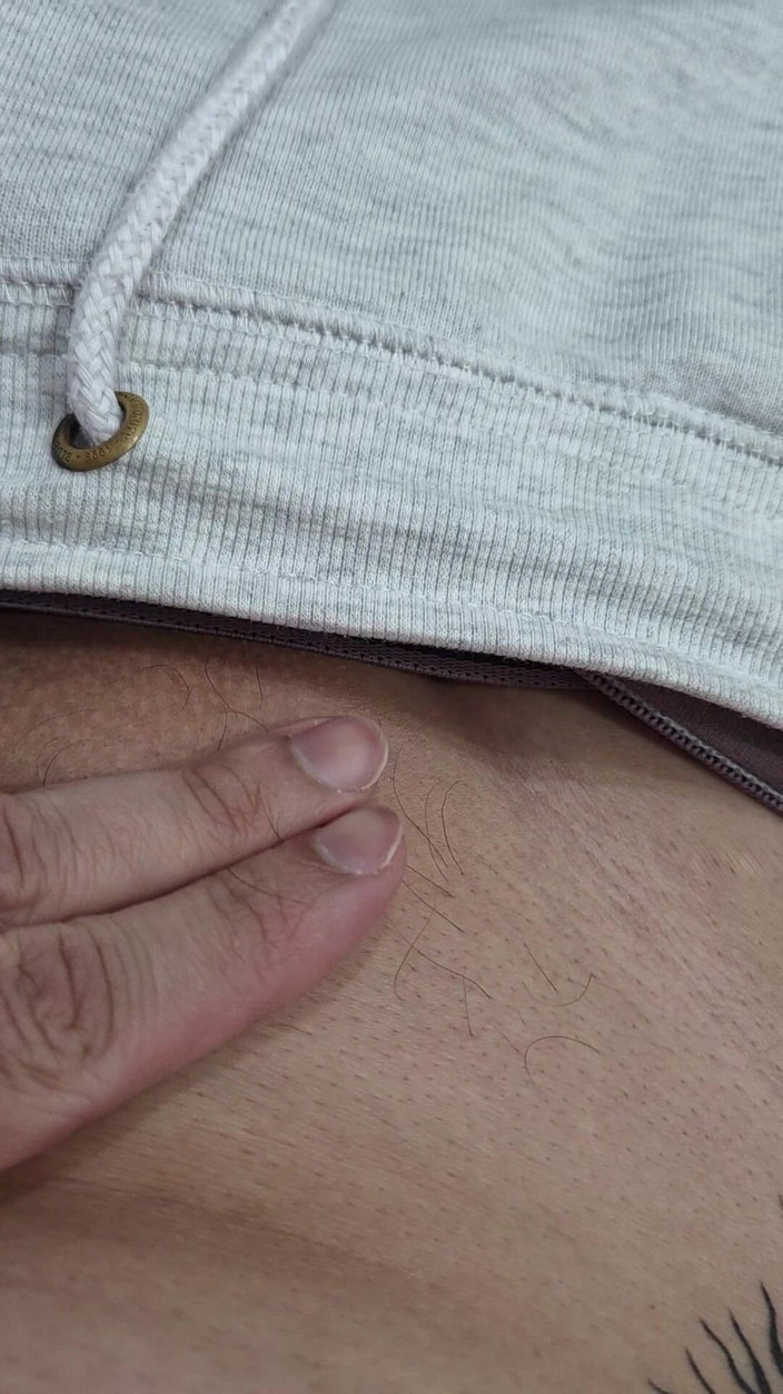 Lkdick8: Lông trên dương vật của tôi - Triệt lông Led