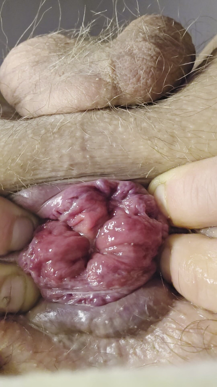 Nalekhome: Moje malá růže a prstění zadku