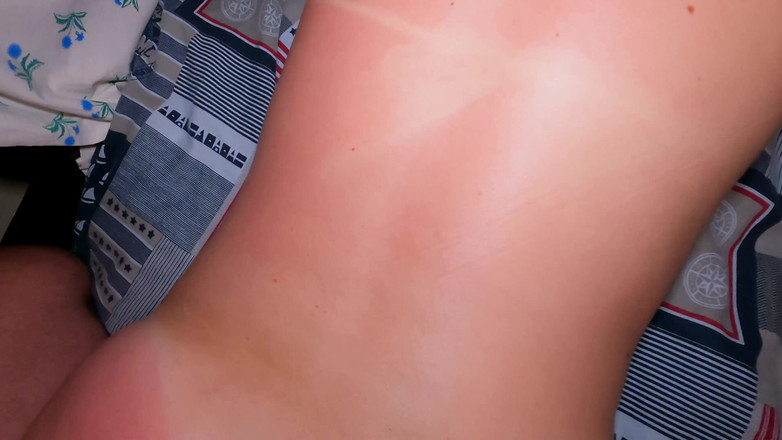 Love_Adventures: Min styvsyster blev solbränd och bad om hjälp!