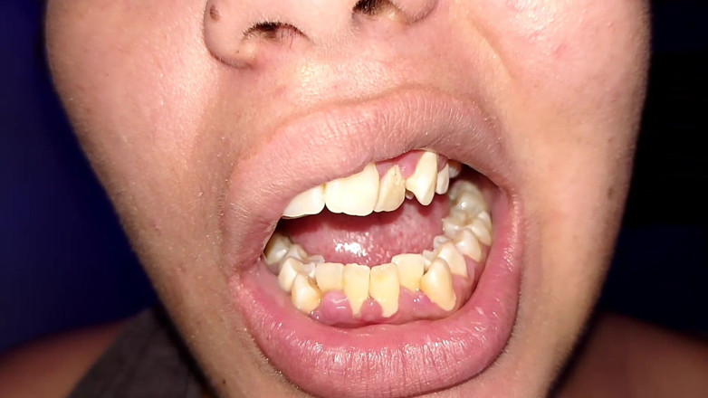 Elimoon: Cố gắng sử dụng chỉ nha khoa (cận cảnh)