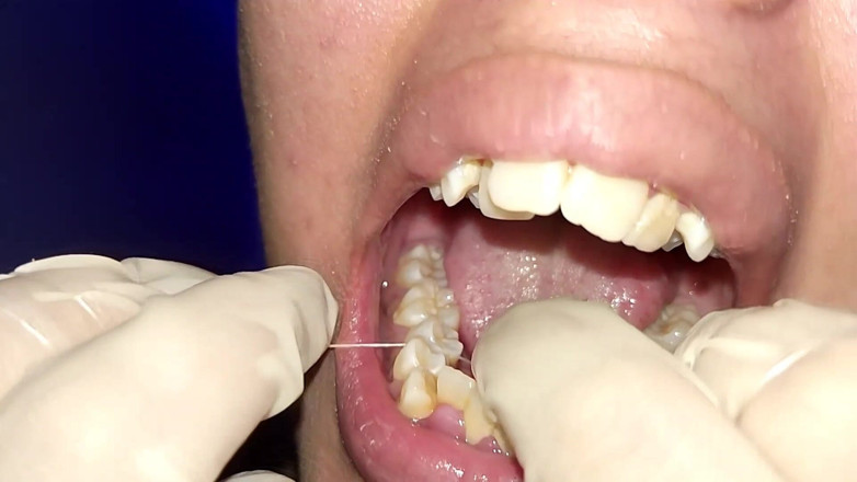 Elimoon: Diş Ipi Kullanmaya Çalışmak (Yakın Çekim)