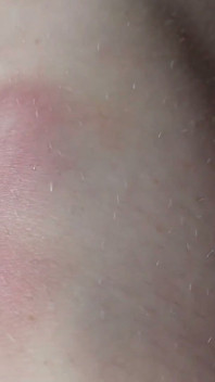 I Show You the Bruises on My Legs After Rough Sex