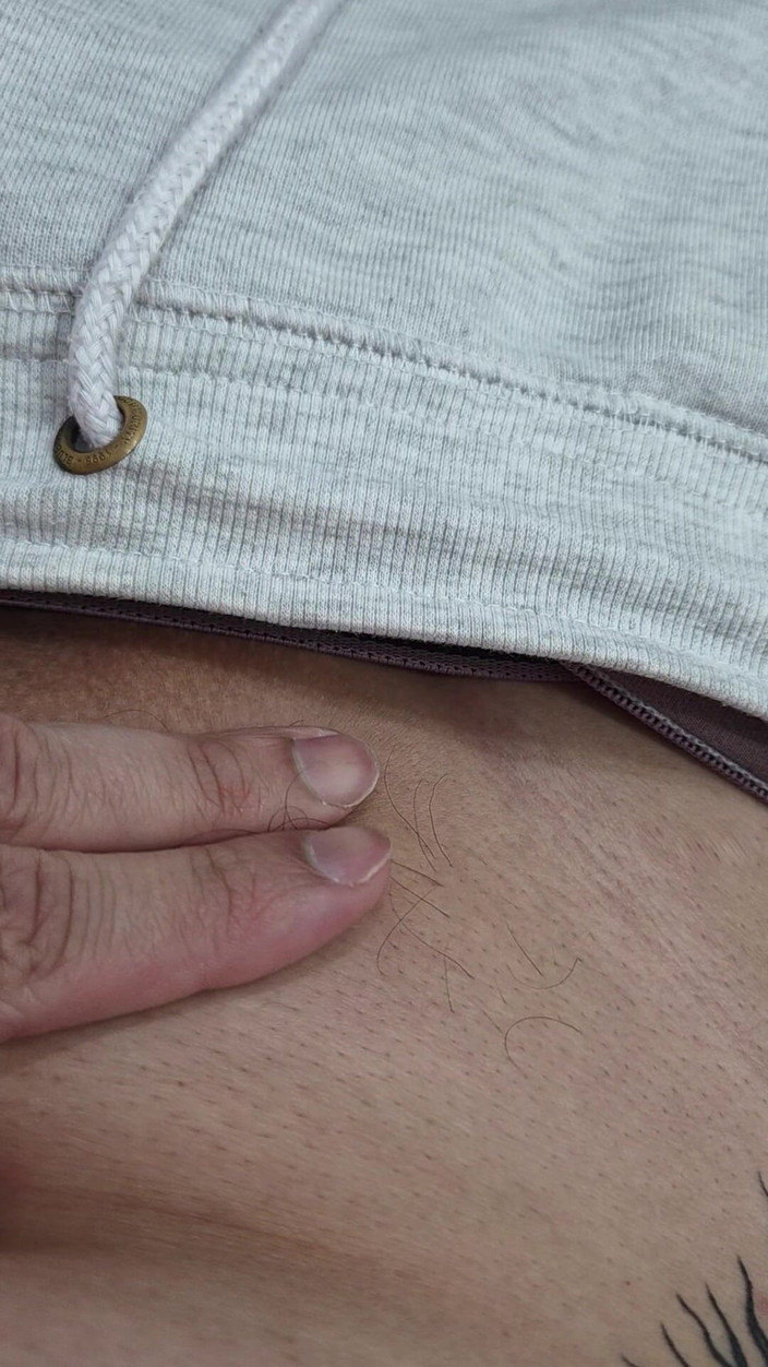 Lkdick8: Os Pelos Do Meu Penis - Depilação a Led