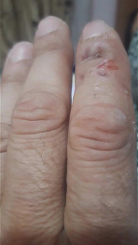 Morso di dito