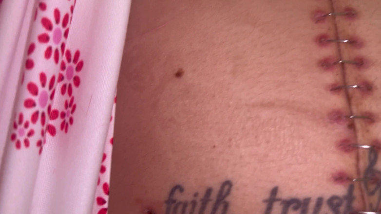 Nali Marie: Scar Fetishes Stitches Staples Hospital Recovery After Surgery Teen Petite...