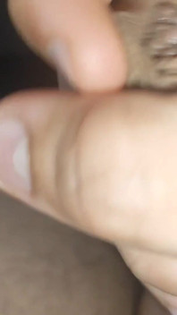 I Have the Largest Ejaculating Phimosis in the World!!