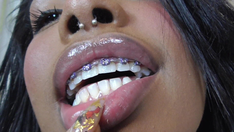 Solo Austria: Black girl teeth brace fetish!