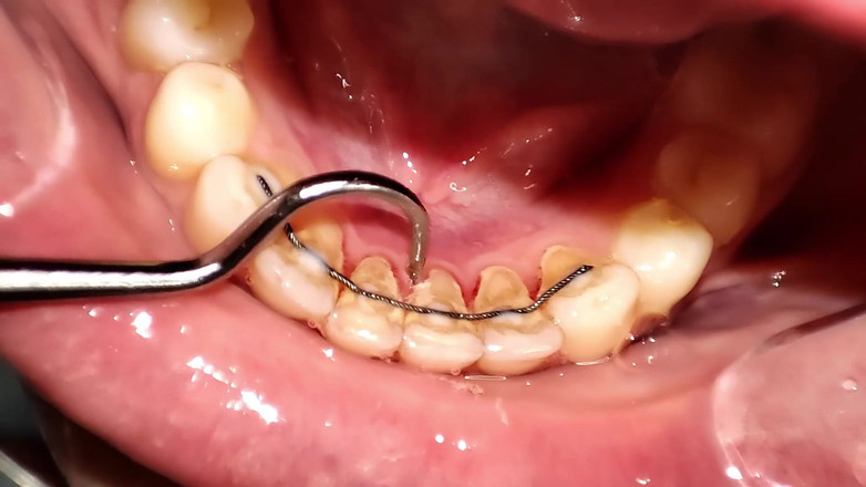 Princess18_: 手動スケーラーによる歯科検診とラフクリーニング