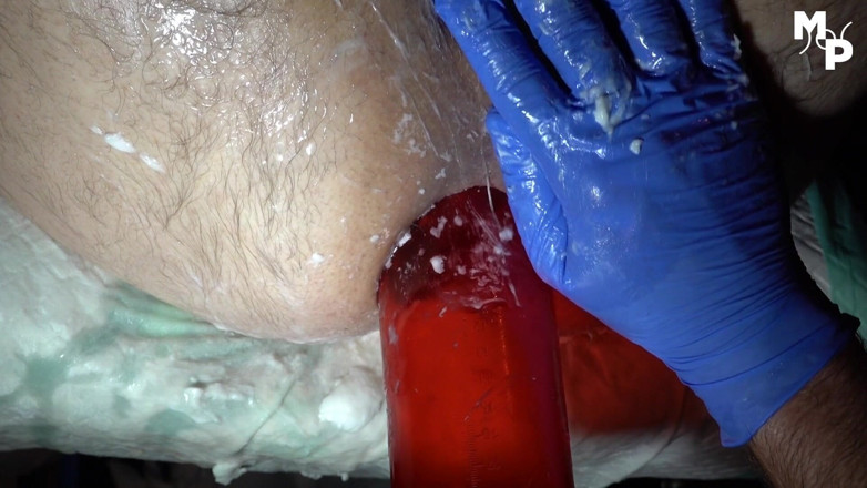 Marcus Pollack Gay: Fisted with rippled gloves and vacuum pumped prolapse