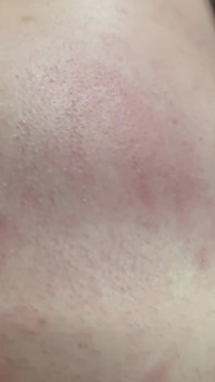 Not Blistered or Bruised yet