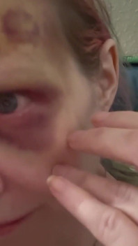Hurting My Own Bruise