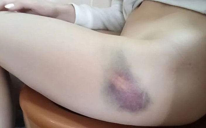 MargoAlisa: Margot Kencing Dengan Lebam Besar Pada Kakinya